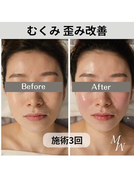 ミピマム 横浜駅前店/小顔コルギ むくみ Before After