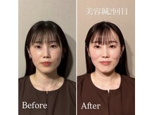 鍼灸院エミュ(Emu)/美容鍼2回目の変化