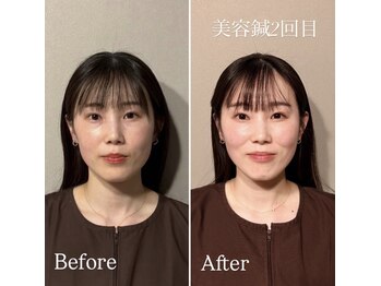 鍼灸院エミュ(Emu)/美容鍼2回目の変化