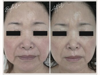 ミューベル(MYubelle)/赤みシワ改善 水光ピーリング