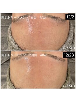 シースキン 盛岡駅前店(c.skin)/お客様ビフォーアフター♪