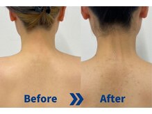 ストラッシュ 草津駅前店/施術例：背中