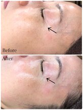 アンティミテ(Intimite)/【スキンケアコース】しわ改善