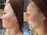 【長年のトラブル肌に】繰り返す悩みに寄り添う鎮静｜美肌フェイシャル