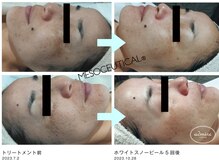 アドミーロ/ホワイトスノーピール/5回＋α☆