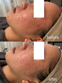 マハロ(mahalo)/赤み鎮静ケア