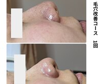 ボニータ(Bonita)/毛穴エクストラクション