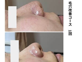 ボニータ(Bonita)/毛穴エクストラクション