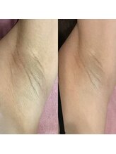 ドクターメラニン ラボ トーキョー 渋谷(Dr. Melanin Labo TOKYO)/脇メラニンケア症例