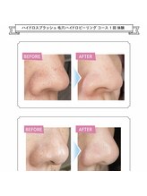 イリゼ(IRISE)/気になる小鼻もお任せください♪