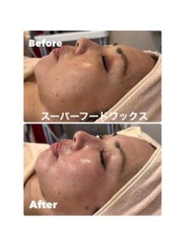 ティアラ(TIARA)/【毛穴、産毛】ワックス脱毛