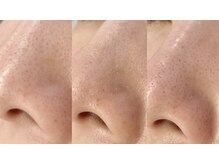 エミリー 守山(EMILY)/【症例写真】毛穴洗浄 (5)