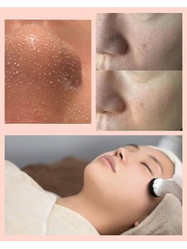 エスボーテ(sbeaute)/プラズマ+毛穴ケア+肌改善