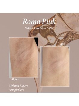 ヨウン 大阪心斎橋(yeoun)/ローマピンク大阪/メラニンケア