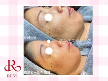 ラティーナ(Lattina)/陶肌ピール