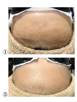 クサカンムリ(KUSAKANMURI)/女性おでこ