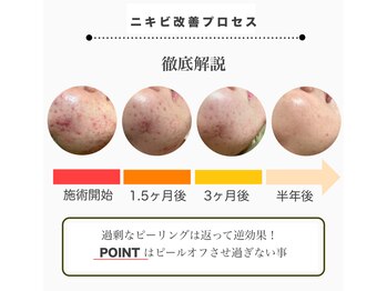 ピブ(PIBU)/ニキビケアのプロセス1