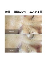 ヒール(heal)/70代　眉間のシワ
