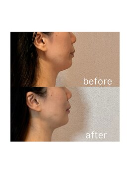 アトリエドゥアージュ(Atelier de age)/光糸[コウシ]リフト