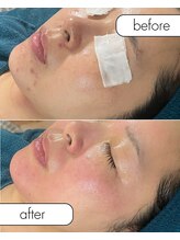 リノルーア(Linolua)/天然ハーブで肌生成！！