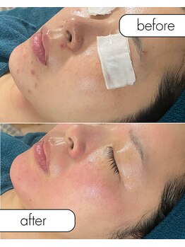 リノルーア(Linolua)/天然ハーブで肌生成！！