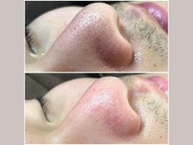 セリジェ 青山(Cerisier)/男性こそ気になる毛穴！！！