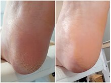 アンティ(Aunty)/踵のガサガサもすべすべスッキリ