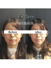 リフェイス(Re:face)/小顔だけでなく肌の色が明るく！