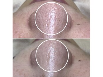 ビオルブ(VIOLVE)/ハーブピーリング/毛穴洗浄