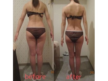 プロラボスパ 新宿店/30代前半 痩身症例