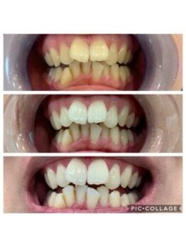 NA ホワイトニング 川崎溝の口店/ホワイトニング/川崎/溝の口