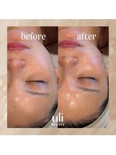 ウリ(uli beauty)/比較写真