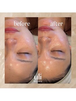 ウリ(uli beauty)/比較写真
