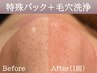 【毛穴汚れ/黒ずみ/老化角質】特殊パック＋毛穴洗浄＆吸引＋引き締め（90分）