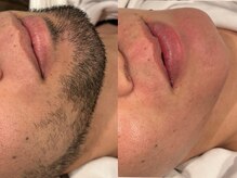 クラウン 心斎橋店(CROWN)/顎髭ワックス脱毛