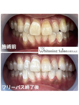 ホワイトニングサロン 京都烏丸店/ホワイトニング施術例