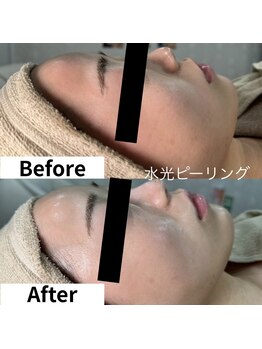 ルミネル 名古屋新栄(Luminelle)/水光ピーリング