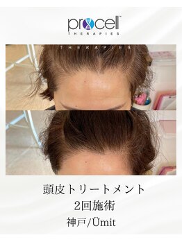 ユミト(Umit)/プロセルスカルプ