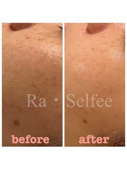 ラ セルフィー(Ra Selfee)/毛穴やシミにアプローチ♪