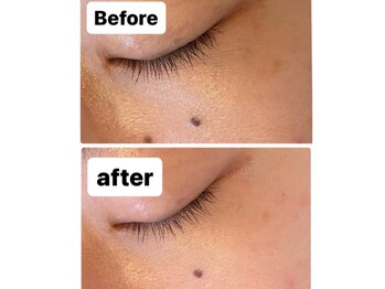 ルルン(LuLuN)/毛穴洗浄後のポレーション導入