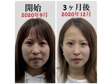 きらめき鍼灸治療院/3ヵ月美容鍼をした結果！