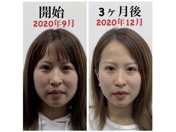きらめき鍼灸治療院/3ヵ月美容鍼をした結果!