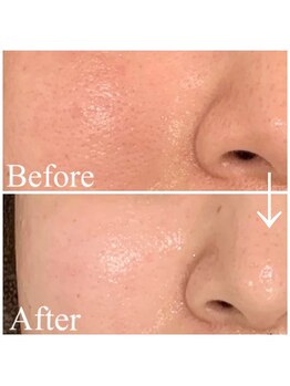 サロン レインボー(SALON RAINBOW)/ハーブピーリングBefore/After