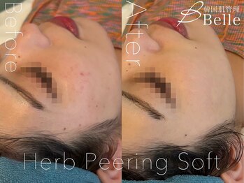 ベル 渋谷(belle)/ハーブピーリング|ニキビケア