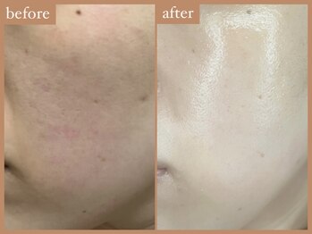 リムーン 岡崎(Re'moon)/REVI ハーブピーリング