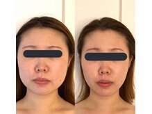 ハイコガオ(HIKOGAO)/小顔矯正40分