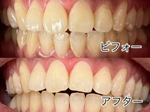 ソレイユ(Soleil)の雰囲気(ビフォーアフター(プレミアムホワイトニング1回後))