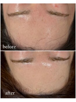 ベル(Bell)/REVIハーブピーリング