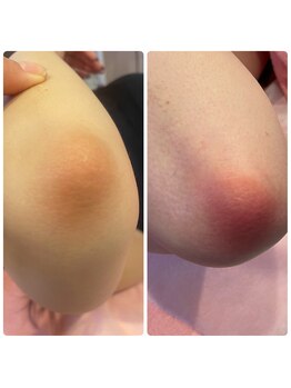 ヒメミ(Himemi)/ローマピンク ひじ