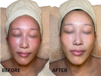 エングラッシー(en glassy)/BEFORE　AFTER　20代